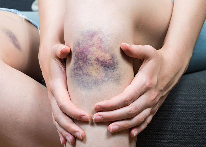 large-bruise-on-knee
